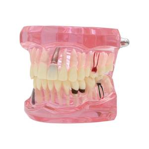 lot 2469 image: Dentalmall Teeth Model Teeth Typodonts Dental Implant Study Analysis Demonstration Teeth Model #2001 with Restoration Pink