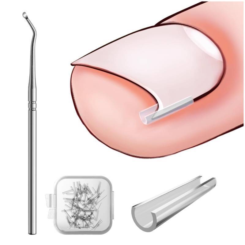 lot 72678 image: Ingrown Toenail Corrector Set - 40 Pcs Pain-Free Toenails Straightener Strips with Toe Nail Lifter - Easy Use Ingrown Toenail Tools Kit - Retail $6