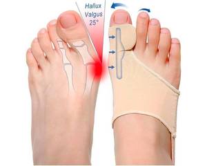 lot 1166 image: ELFON Bunion Corrector for Women Men �� Orthopedic Big Toe Straightener with Soft Gel Support, Hallux Valgus Pain Relief Splint & Separator, Day & Night Use, Fits in Shoes - Retail $0